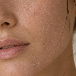 Dryness & Dehydration