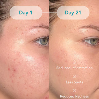 Comprehensive Acne Treatment
